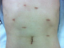 腹腔鏡下胃全摘術の創部